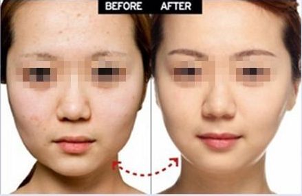 上海眼部整形醫(yī)院推薦，雙眼皮修復(fù)效果好