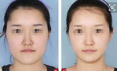鄭州眼睛修復哪家醫(yī)院效果好 鄭州眼睛修復哪家醫(yī)院效果好