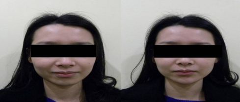 溫州哪家醫(yī)院割雙眼皮好？附醫(yī)院醫(yī)生介紹及價格參考