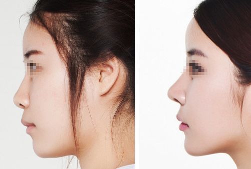 汕頭名流整形醫(yī)院：拉雙眼皮、吸脂價格一覽，專家解讀真實(shí)案例