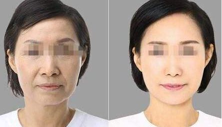 寧波玻尿酸去法令紋效果評價一覽