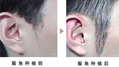 開眼角手術改善眼型，揭秘適合人群