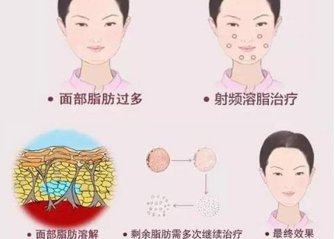 韓國整形醫(yī)院眼鼻綜合對比：普露菲耳 vs POP