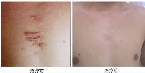南寧做玻尿酸隆胸醫(yī)生