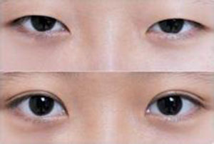 太原眼睛細(xì)紋去除醫(yī)生