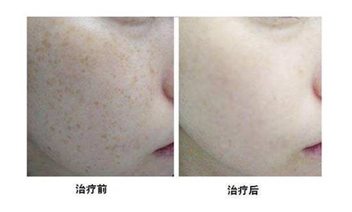 南京鼻部精細埋線提升醫(yī)生