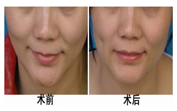 湖州雙眼皮手術(shù)機(jī)構(gòu)推薦：3家優(yōu)質(zhì)醫(yī)院完美整形，放心選擇