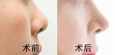 重慶現(xiàn)在有哪些當(dāng)代鼻子整形醫(yī)生值得關(guān)注？參考謝錦清和曾高醫(yī)生的口碑評價
