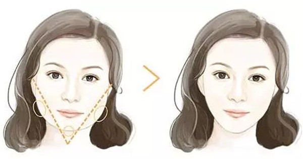 長春法令紋去除手術醫(yī)生