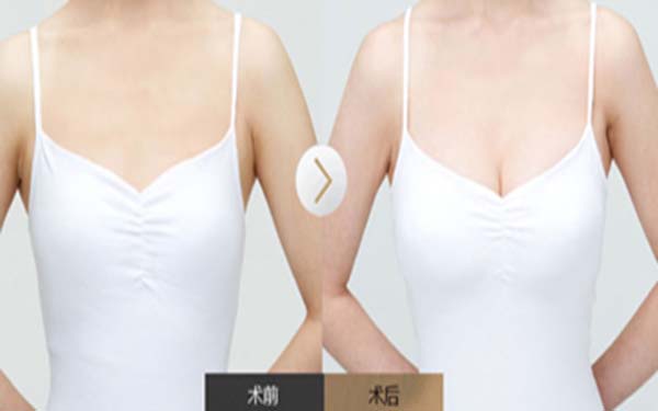 武漢玻尿酸填充額頭醫(yī)生