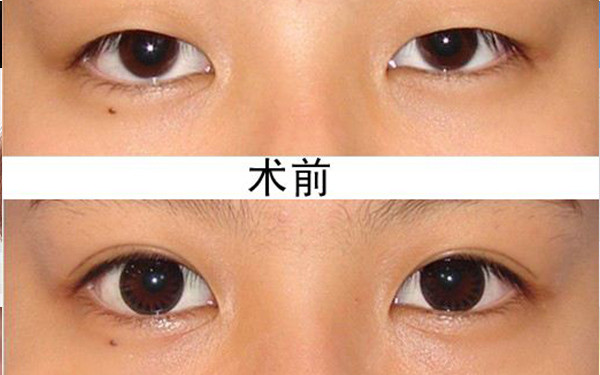 2023西安鼻基骨縮窄手術醫(yī)院排名前10強，值得信賴的口碑推薦！
