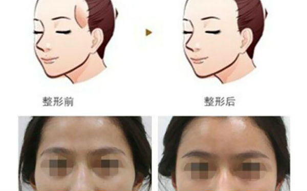 洛陽哪家醫(yī)院做木偶紋效果好？2023榜單出爐，洛陽物理去木偶紋top10佳選露面！
