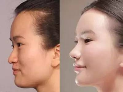 2023年，哪些上海自體脂肪面部精雕整形醫(yī)院的口碑特別好？排名榜前十值得信賴的美容整形醫(yī)院！