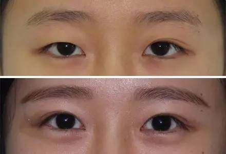 杭州駝峰鼻矯正哪家整形醫(yī)院技術(shù)獨(dú)特？2023杭州駝峰鼻矯正排名前10的醫(yī)院評測揭曉！