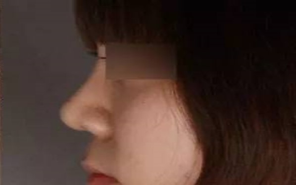 重慶哪家整形醫(yī)院祛黑眼圈效果靠譜？2023年重慶祛黑眼圈醫(yī)療機(jī)構(gòu)排名前十值得信賴嗎？