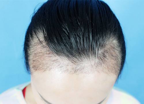 宜賓市哪家整形醫(yī)院專業(yè)豐額頭術(shù)效果好？探尋宜賓自體脂肪豐額頭術(shù)醫(yī)院口碑佳！2023宜賓豐額頭術(shù)推薦前十技