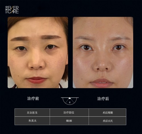 阿爾法9°美眼，打開視界，美無(wú)止境