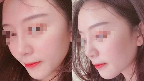 耳軟骨隆鼻術(shù)后三個月，我有了韓佳人同款美鼻