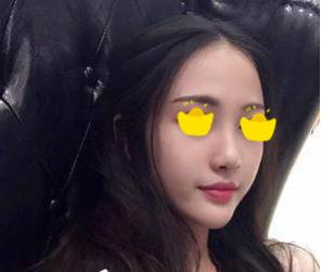 塌鼻子小妹在深圳鵬愛做隆鼻手術(shù)，三個(gè)月后竟然是這樣的