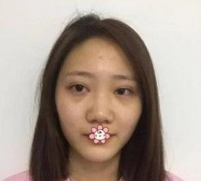 北京彤美耳軟骨隆鼻三個月效果分享，吐血推薦