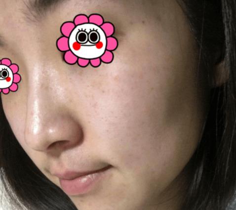 溫州韓美整形激光祛斑案例治療后三天效果