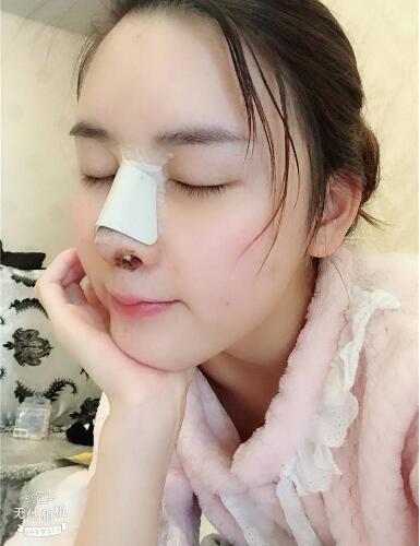 北京哪家隆鼻好？花一萬(wàn)鼻子做成這樣值不值