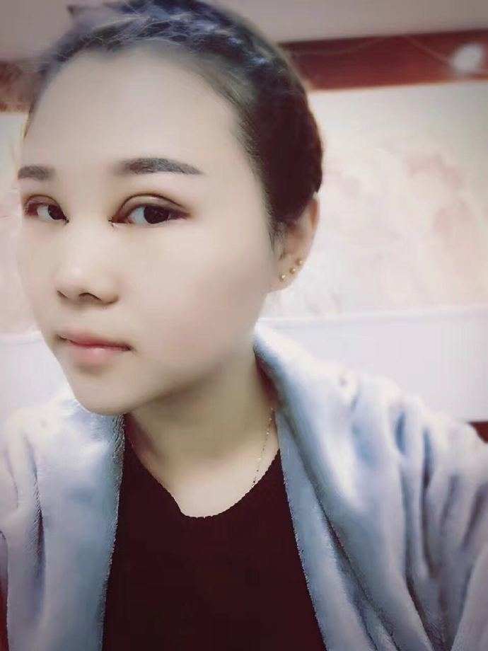 腫眼泡應(yīng)該做哪種雙眼皮？汕頭曙光雙眼皮三個月效果分享