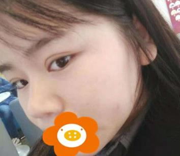 據(jù)說杭州薇琳隆鼻后效果很自然，有案例嗎