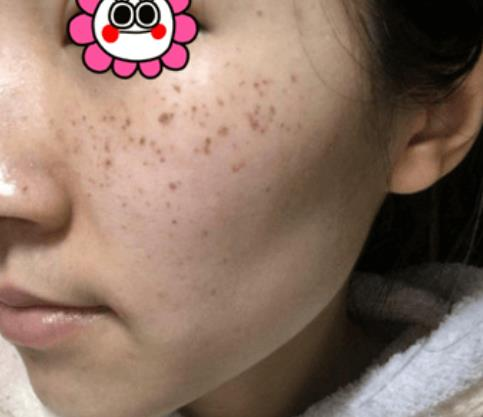 困惱我多年的斑，沒想到在溫州韓美三千塊錢就去掉了
