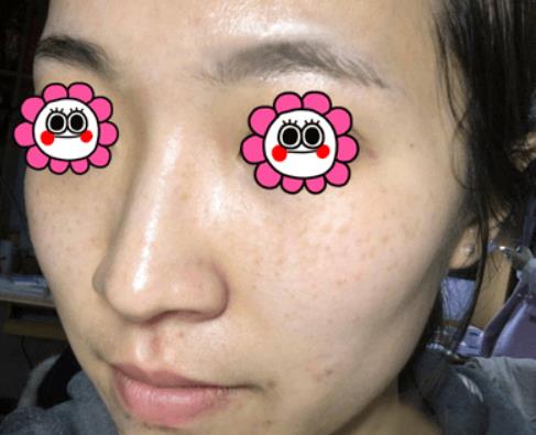 溫州韓美整形激光祛斑案例治療中效果