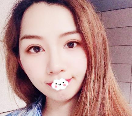 武漢伊萊美割雙眼皮怎么樣？切開雙眼皮恢復(fù)過程圖