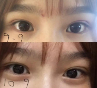 做雙眼皮案例，濟(jì)南坤如瑪麗崔金珍雙眼皮案例圖片