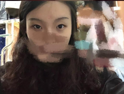 做雙眼皮案例，北京藝星張順慶雙眼皮案例圖片
