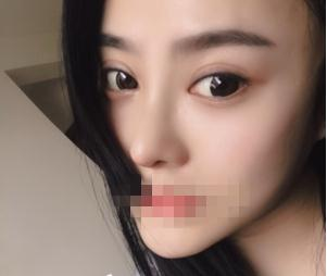 親身經(jīng)驗，重慶星范整形的超體隆鼻真的很自然