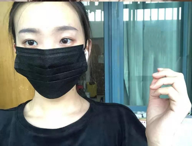 做雙眼皮案例，北京藝星張順慶雙眼皮案例圖片