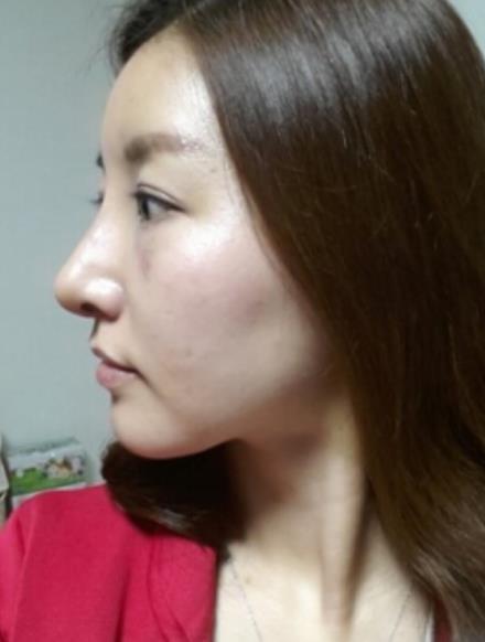 武漢中翰整形駝峰鼻矯正案例術(shù)后一個(gè)月效果