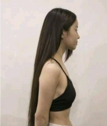 青島集美蜜桃假體隆胸案例術(shù)前效果