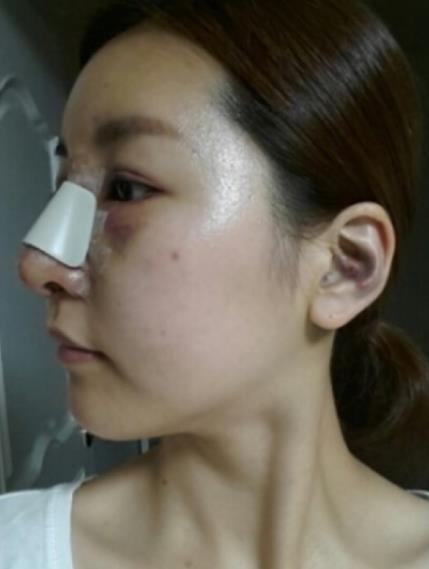 武漢中翰整形駝峰鼻矯正案例術(shù)后第二天效果