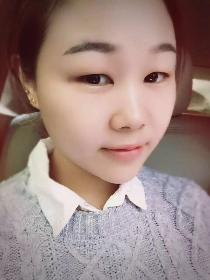 腫眼泡應(yīng)該做哪種雙眼皮？汕頭曙光雙眼皮三個月效果分享