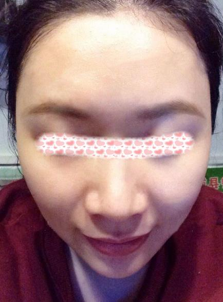 像我一樣寬鼻翼的小姐姐們可以放心找李旭平做隆鼻了，親測好評