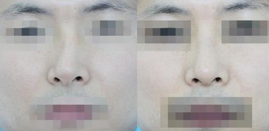 不要被營(yíng)銷號(hào)帶偏了，鼻骨矯正其實(shí)很簡(jiǎn)單