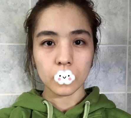 大連沙醫(yī)生整形付德林做的自體軟骨隆鼻效果，給大家做個(gè)參考
