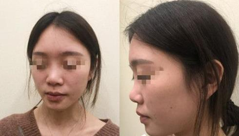耳軟骨隆鼻術(shù)后三個月，我有了韓佳人同款美鼻