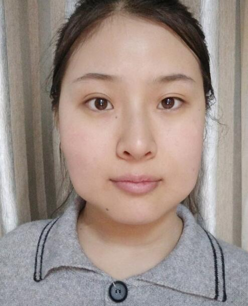 杭州時光磨骨前后對比，你整成這樣還缺王思聰嗎