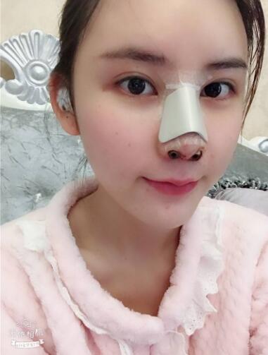 蘭州美月做膨體隆鼻術(shù)后第二天效果