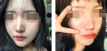 一個鼻子讓一張臉迅速高級，還不考慮做個鼻綜合嗎