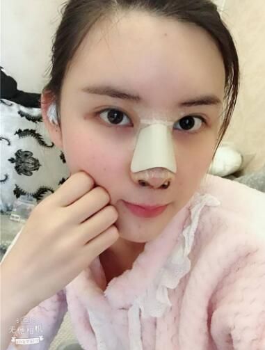這么好的效果，不來蘭州美月做膨體隆鼻真是白瞎了醫(yī)生的技術(shù)