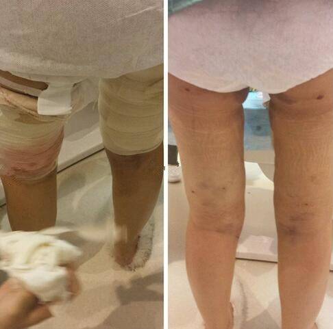 4800做的大腿吸脂，效果竟然還不錯(cuò)