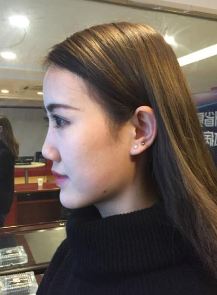 北京藝美整形鼻綜合案例分享，我都忍不住多看了兩眼