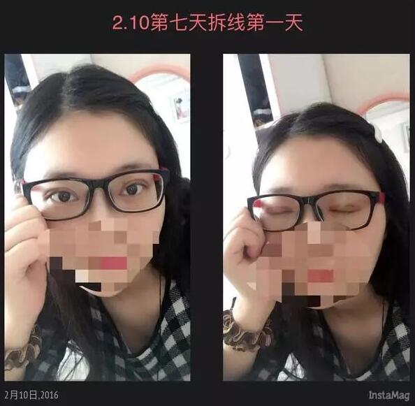 北京京民雙眼皮修復(fù)案例術(shù)后拆線效果